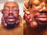 Man With Keloids On His Face Appeals For Help And Squeezes Some