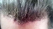 This Video Of A Man's Disgusting Head Lice Infestation Will Make Your Skin Crawl