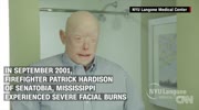 Firefighter recovering from historic face transplant surgery