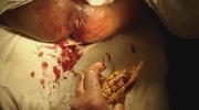 Removal Of A Corn On The Cob From A Guys Asshole