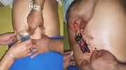 Rat Pulled From Inside A Man’s Belly In Brazil!