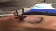 Woman with bullet in the eyebrow