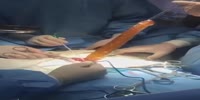 Huge dildo fun ends in surgery