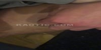 Metal ball in the leg ;)