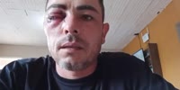 Man Loses An Eye In Battery Explosion