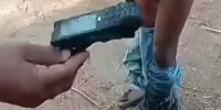 Phone Explosion Nearly Castrated Poor Dude