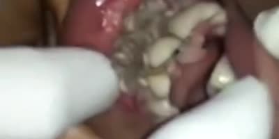 Maggot mouth