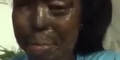 Victim Of An Acid Attack
