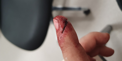 Angle grinder bit me