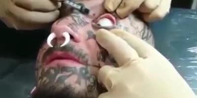 Moron getting black ink injected in his eye.