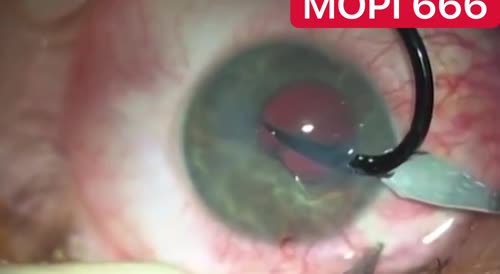 Hook in eyeball surgery.