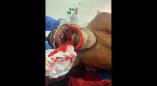 Man loses his eyes and jaw, thanks to a bull.