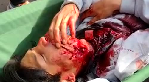 Young man shot in the face in Peru, aftermath