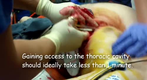 Thoracotomy on motorcycle accident victim.