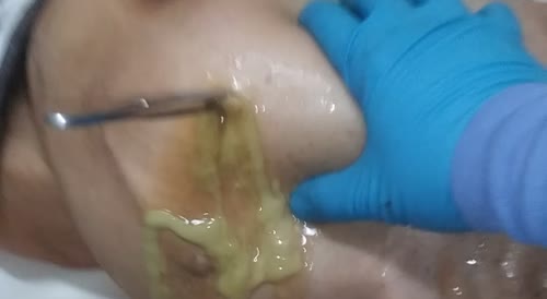 Gallons.of pus drained