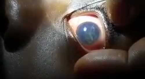 Eye Worm Is Common Thing In Africa