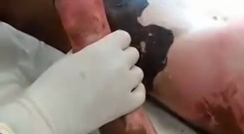 Pealing skin off of a burn victim.