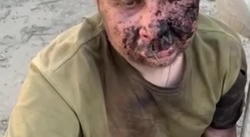 Russian POW with fucked up face taken by ukrainian troops