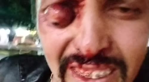 Man Loses Eye After Being Mistaken For a Thief