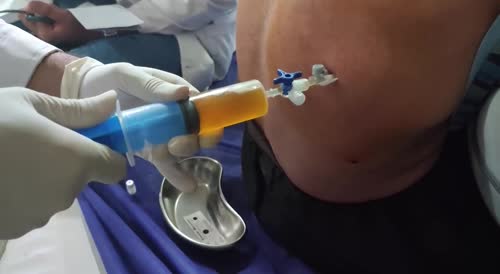 Removing 1000cc of fluid from a human lung.