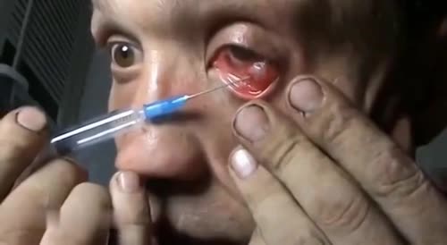 Schizophrenic Russian Injects Drugs into His EYE