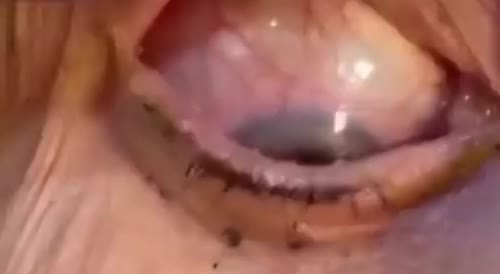 Woman goes to doctor to take her eye contact off and she removes 23 of them