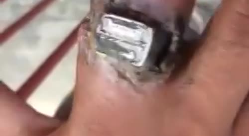 Finger stuck with engagement ring