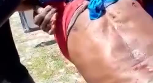 Jamaican man gets his arm ripped off by a shark.