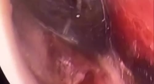 Spider Crawls into Man's Ear - Makes Nest