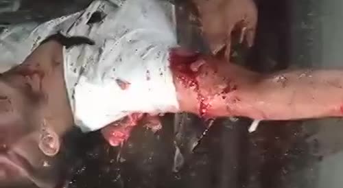 Gruesome Accident In Colombia