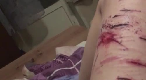 Intoxicated Woman Shows Her Recent Leg Wounds