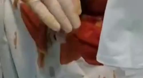 Huge dildo removed from a man's ass, doctors laugh out loud