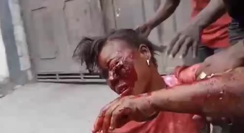 Poor Woman Shot In The Eye By Stray Bullet In Haiti