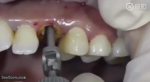 Dentists Pulls Tooth