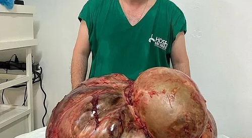 Woman With 45kg Tumor Removed [1-5 images]