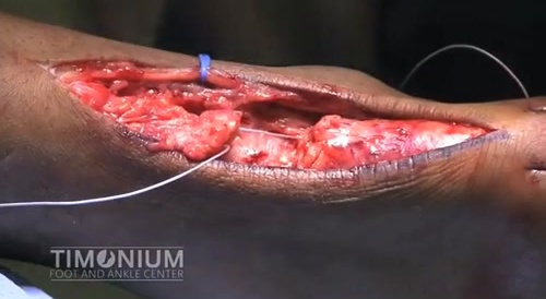 Achilles Tendon Repair