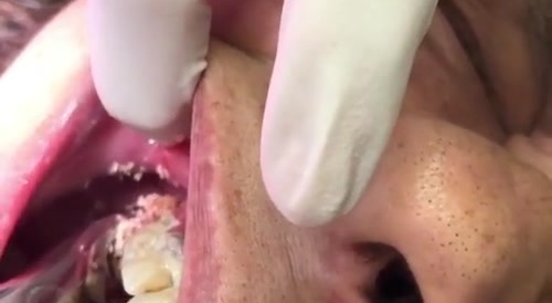 Dentist removes extreme 'tartar' from womens teeth