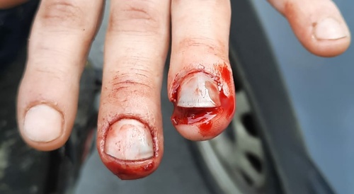 I can’t believe it myself , I crushed my finger :D