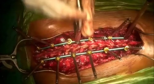 Posterior Thoracic Surgery For Scoliosis