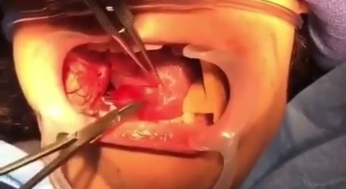 Cyst Removal