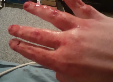 I cut my hand