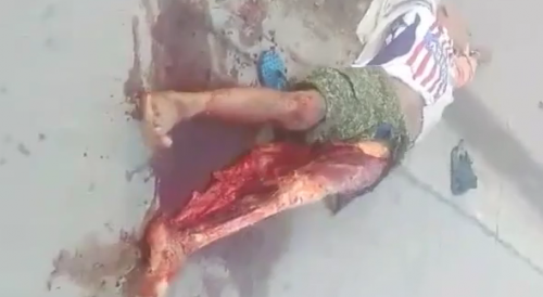 Old Man Left With Leg Skinned After An Accident