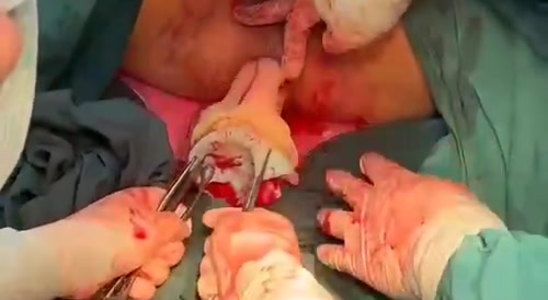 Another Dildo Extracted From Male Ass