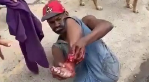 Dominican Man Got Foot Ripped Off In Motorcycle Accident