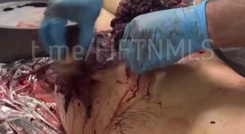 Anus reconstruction surgery on a Ukrainian soldier