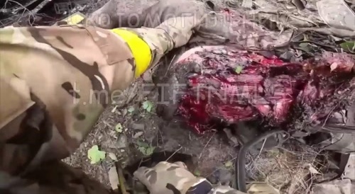 Feel the pain. Ukrainian's leg turned into meat after stepping on a mine