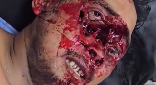 Biker Suffers Terrible Face Injury