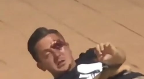 Guy Who Can't Fight Gets Eye Busted