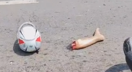 Woman Lost Leg In Motorcycle Accident In Manaus