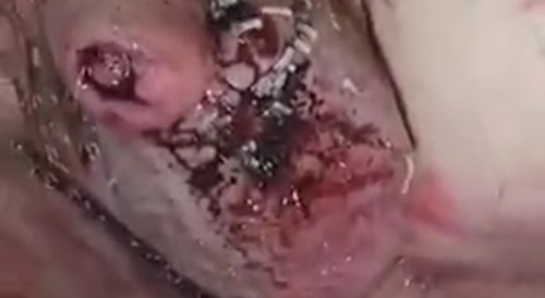 Maggots on Man's Balls - gross!